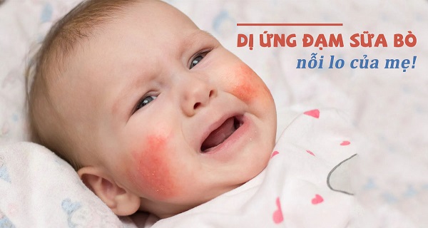 Sữa cho trẻ dị ứng đạm trong sữa bò, bất dung nạp đường Lactose