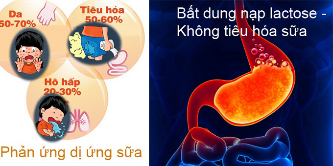 Sữa Similac Isomil IQ cho trẻ 0-12 tháng tuổi lon 400g