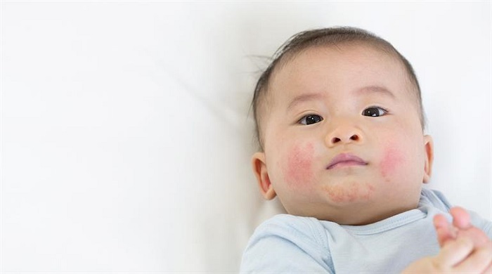 Sữa Modilac Expert Riz 1 lon 800g cho trẻ dị ứng đạm bò 0-6 tháng