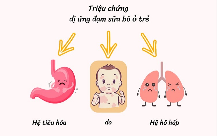 Sữa Novalac Riz cho trẻ dị ứng đạm sữa bò