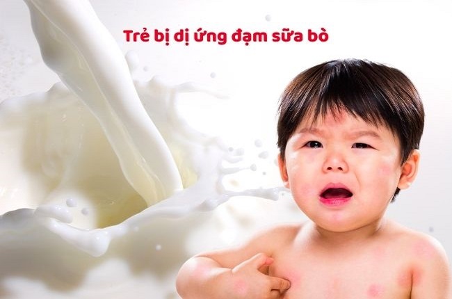 Sữa Novalac Riz AR cho trẻ dị ứng đạm sữa bò
