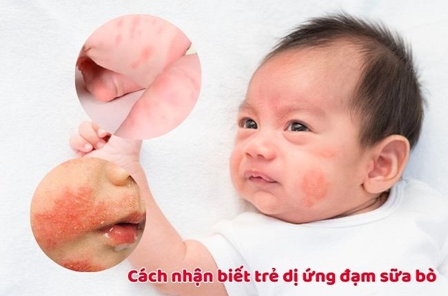 Sữa Novalac Riz AR cho trẻ dị ứng đạm sữa bò